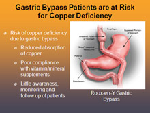 Gastric Bypass Surgery